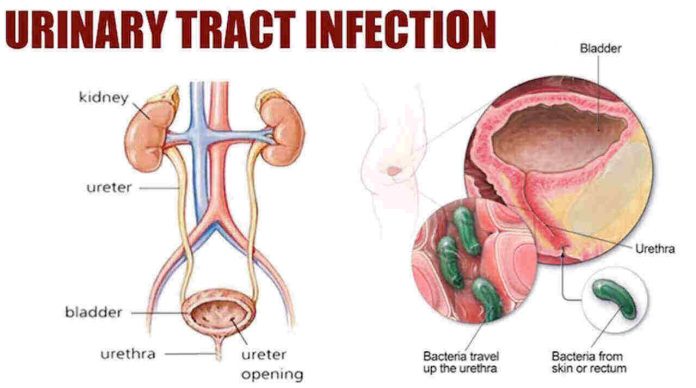 Urinary Track Infection Urinary Track Infection